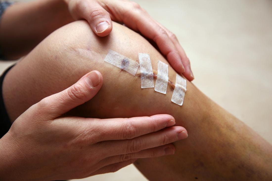 Jus daun bunga bakung untuk obati luka. Sumber: Medical News Today